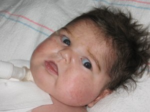 trach-day-2-10-09-004