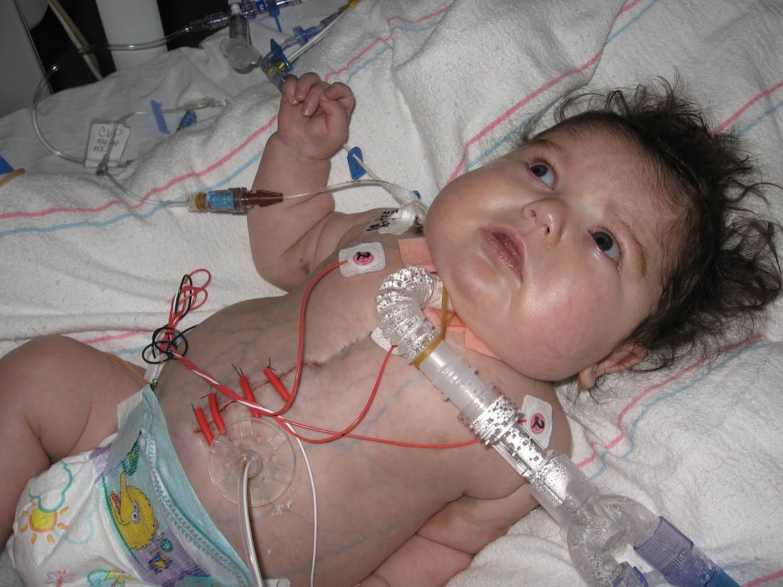 He has some cool Frankenstien-size stitches now...